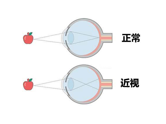 近视,弱视,散光的区别