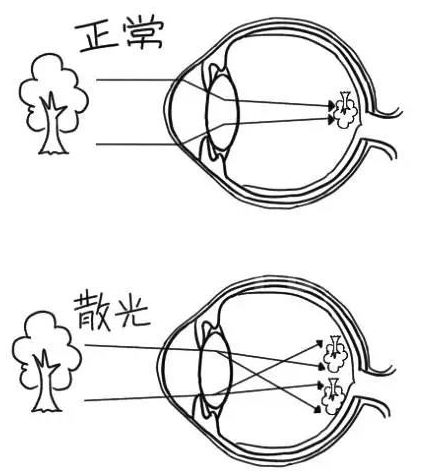 什么是散光